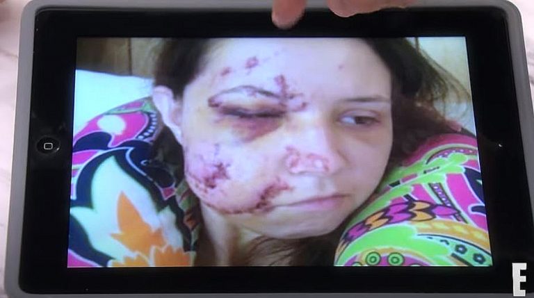 Car Crash Victim With Glass In Her Face Bleeds For Hours In ER, ‘Botched’ On E! Preview
