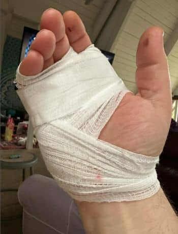 Duff Goldman injured hand - Instagram