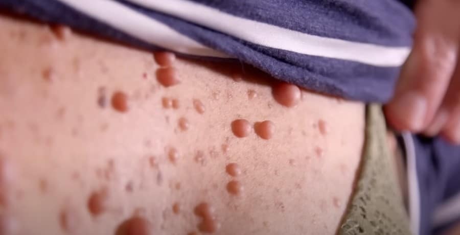 A patient's very pimply back from Dr. Pimple Popper, TLC, sourced from YouTube